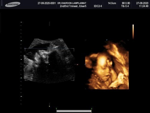 25 weeks 💕🤰🏻