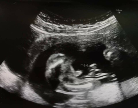 แม่ๆทีม ม.ค.64 รู้เพศลูกกันกี่วีคคะ 🏠นี้18วีค5วัน ค่ะ