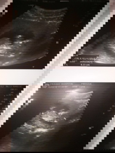 เเม่ๆๆรู้เพศลูกตอนกีวีคค่ะตอนนี้ท้องได้12+5wอยากทราบเพศลูกเเม่ๆช่วยดูหน่อยว่าเพศหญิงหรือชายค่ะ