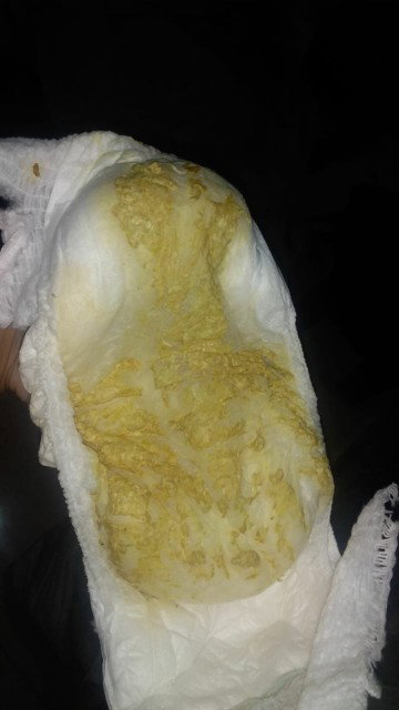 Setiap minum susu langsung muntah dan diare