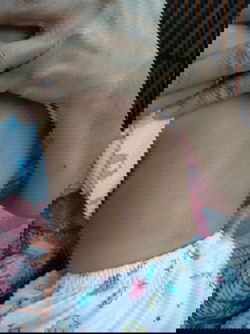 Cara membedakan campak dan uap panas