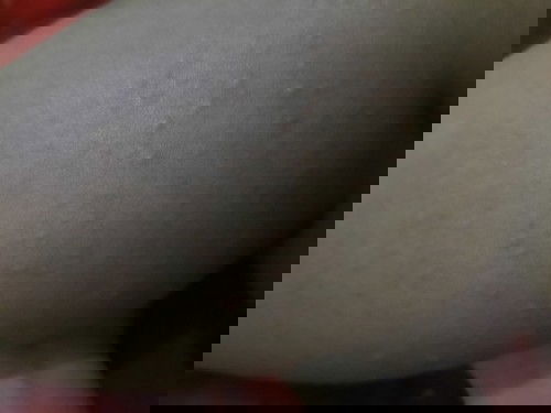 timbul gatal gatal di minggu 27..