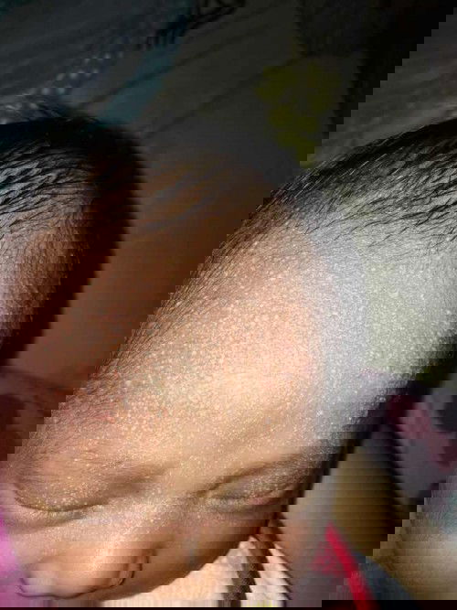 Bruntusan wajah dan leher