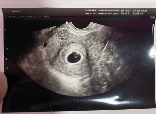 ตั้งครรภ์ได้ 8 week หมอซาวด์ไม่เห็นเด็ก เศร้าเลยค่ะ