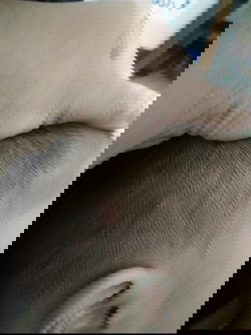 ini bisul bukan yak?