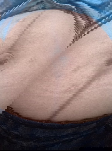 Dark stomach remedy after giving birth