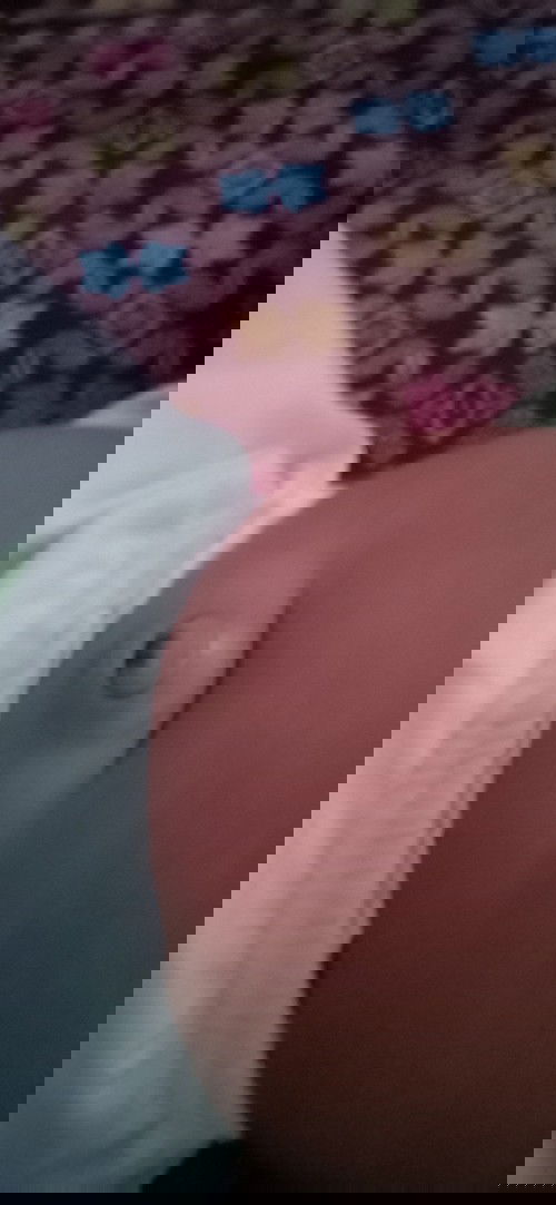 Hernia pusat menonjol