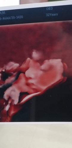 3D ULTRASOUND