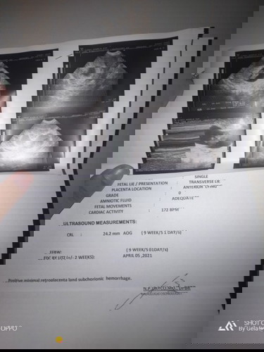 TransV resulta positive minimal ako na my kunti kunyi na muong dugo saakin pero si baby buhay nnmn