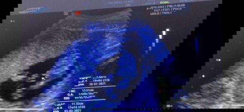 อยากฟังประสบการณ์คลอดธรรมชาติค่ะ