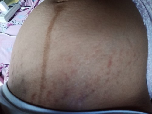 Stretch marks
