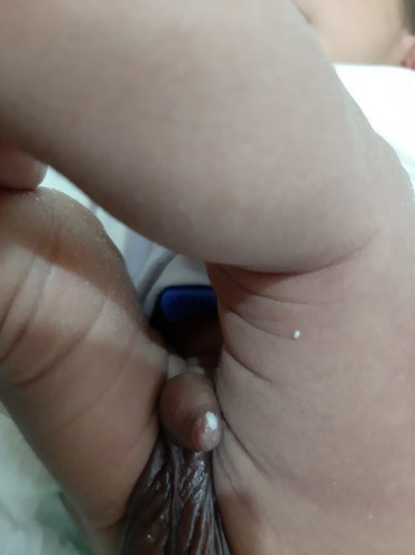 white small pearl like on my baby's penis