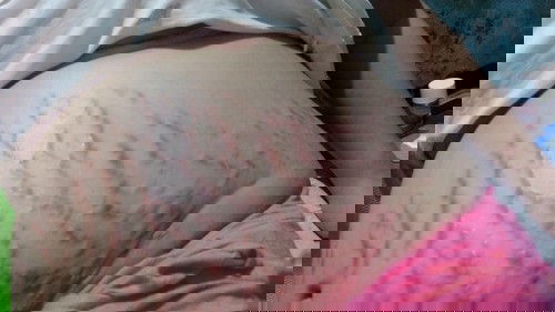 Normal lang ba mag ka Rashes ??