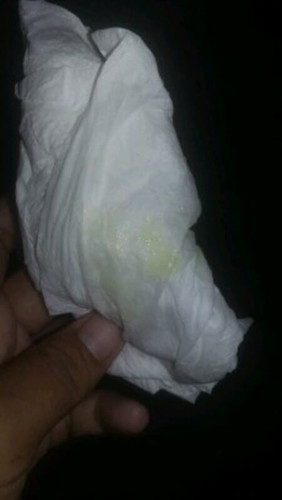 ปวดท้องเเร้วมีเเบบนี้ออก คืออะไรค่ะ