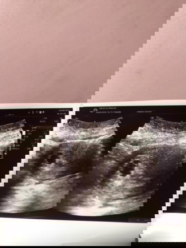 ท้องแล้วค้า รอนานมากค่ะ