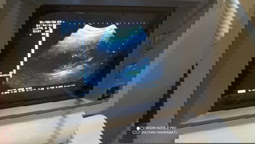 Hasil usg dan hpht berbeda 2 minggu lebih