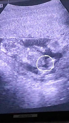 สายสะดือหรือจู๋