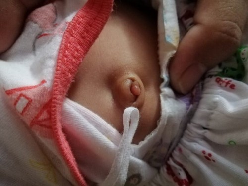 แม่เป็นกังวลใจมากสะดือน้องไม่แห้งสักทีหรือแม่ใจร้อนน้องอายุได้1เดือน3วันคะ