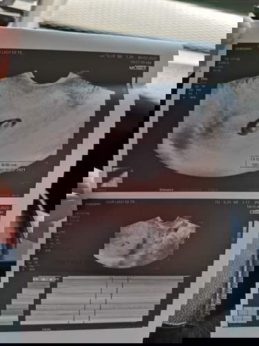 SMALL GESTATIONAL SAC