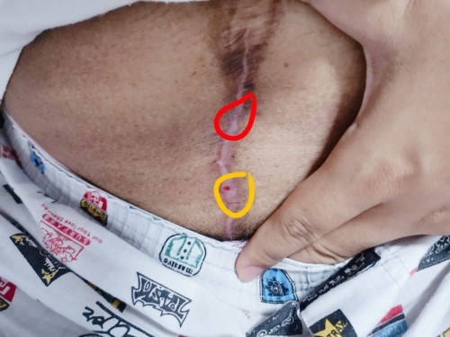 แผลผ่าตัดแบบนี้ปกติมั้ยคะ