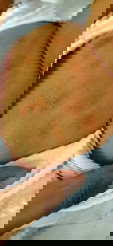 Rashes?
