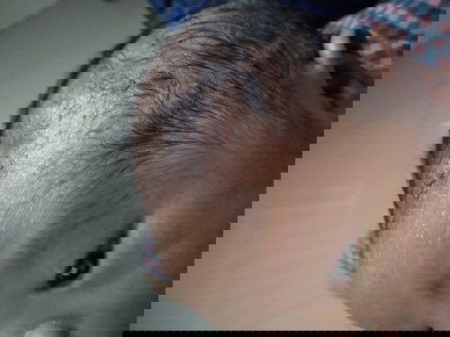 Hilangkan bintik kdang keluar nanah