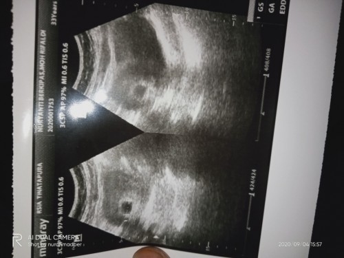 Memang kalo usia janin 5 minggu itu masih kantong yang kelihatan ?