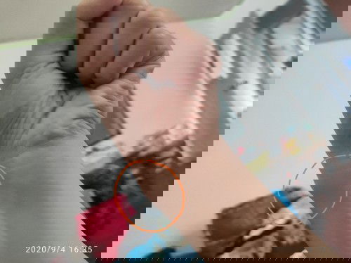 Protruding Bone (both hands)