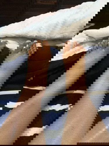 บวมแบบนี้อีกนานไหมคะ