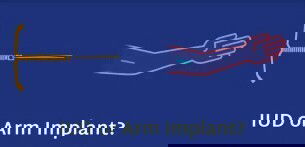 IUD or Arm Implant??