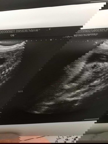 รูปอัลตราซาวด์ล่าสุด