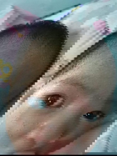 Baby Acne