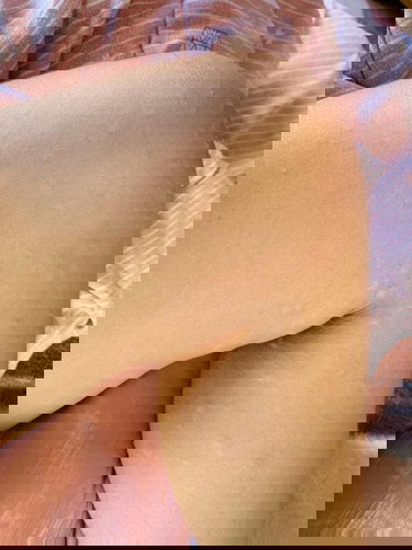 ผื่นหลังผ่าคลอด