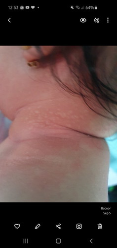 rashes?