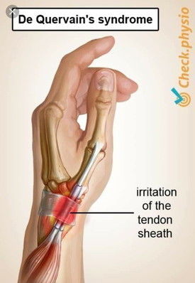 Iritasi tendon sheath