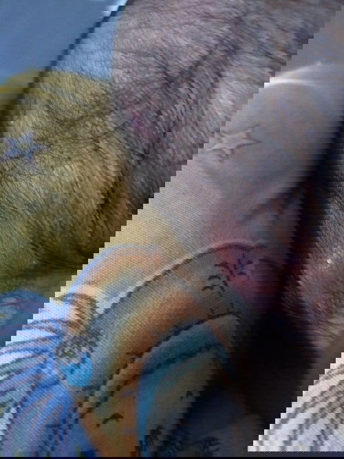 Benjolan/bisul nanah