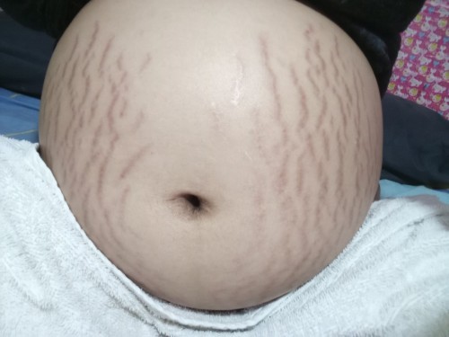 ท้องแตกเยอะมากควรใช้ครีมตัวไหนดีค้ะ😰