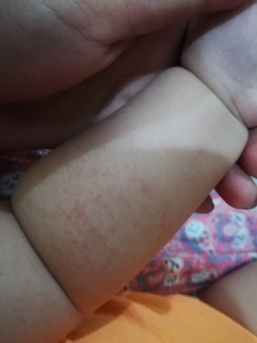 Hello po need help ano po kaya itong nasa braso po ng lo q parang rashes po kulay red sya.. Salamat