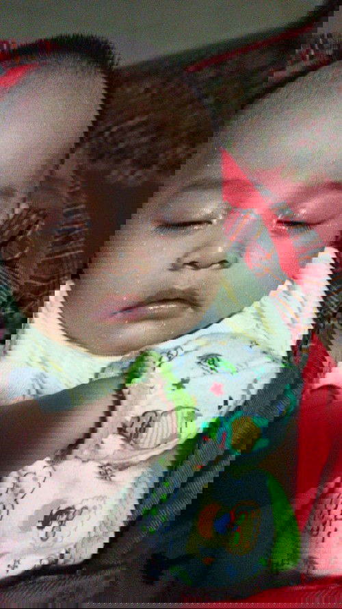 Bentol2 putih di muka bayi