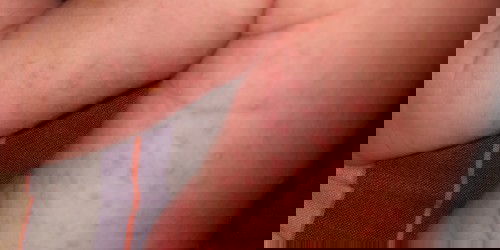 Biang keringat pada bayi