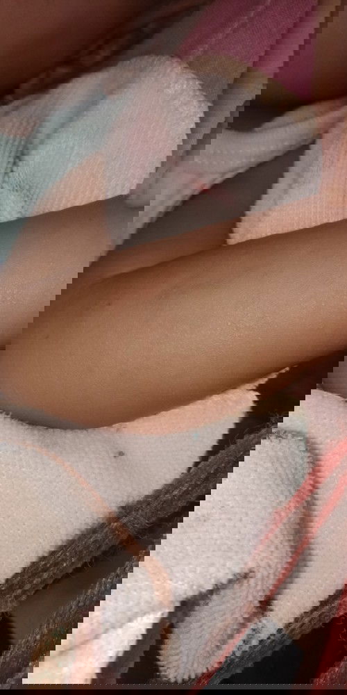 น้องขึ้นผื่นแบบนี้