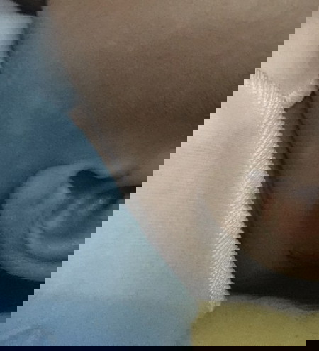 Bercak putih pada bayi