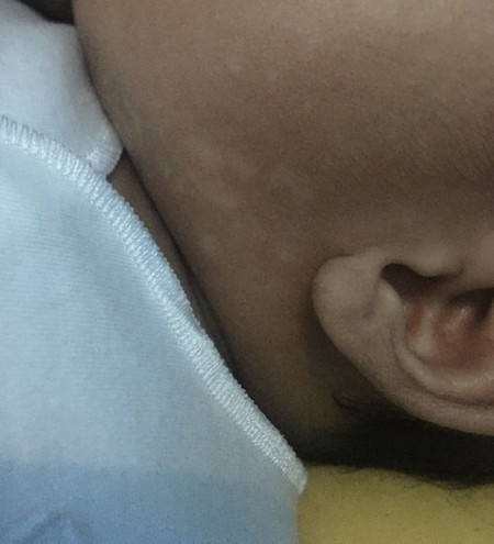 Bercak putih