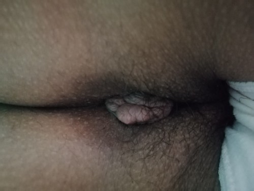 Almoranas/Hemorrhoid