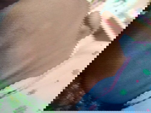 Bunda adakah yg mengalami seperti anak saya, ada bercak putih2 di kepala bagian belakang,,