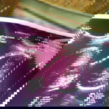 Cara membaca USG yang benar