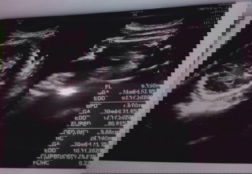 tambah berat badan janin