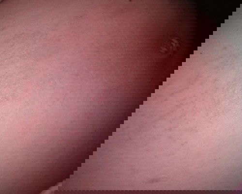 Bintik bintik merah gatal