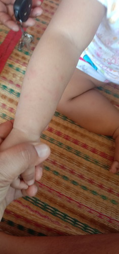 ผดผื่นเป็นมาหลายวันแล้วค่ะ