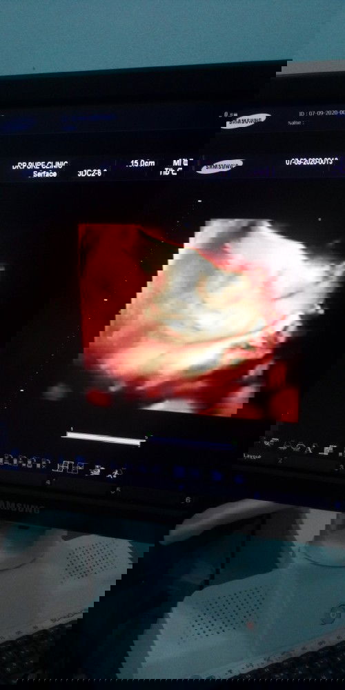 34 สัปดาห์